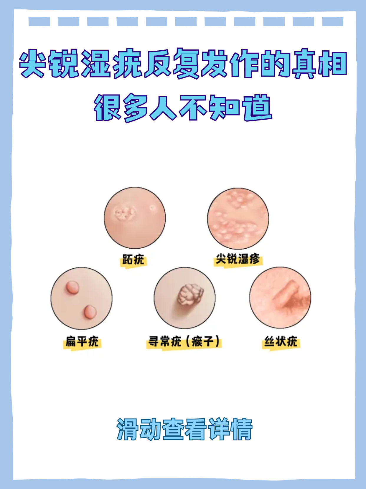 尖锐湿疣怎么治疗才能根治不传染_(尖锐湿疣怎么治疗才能根治不传染家人)  第2张